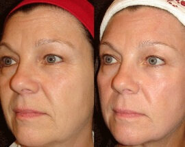 Experience in the use of Bioretin